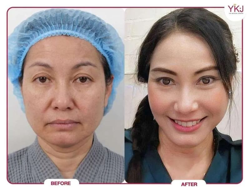 Facelift procedure image