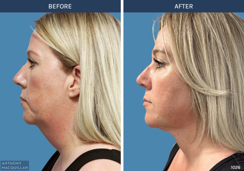 Neck Lift procedure image