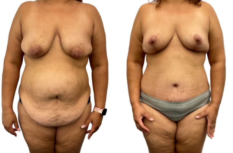 Skin Tightening procedure image