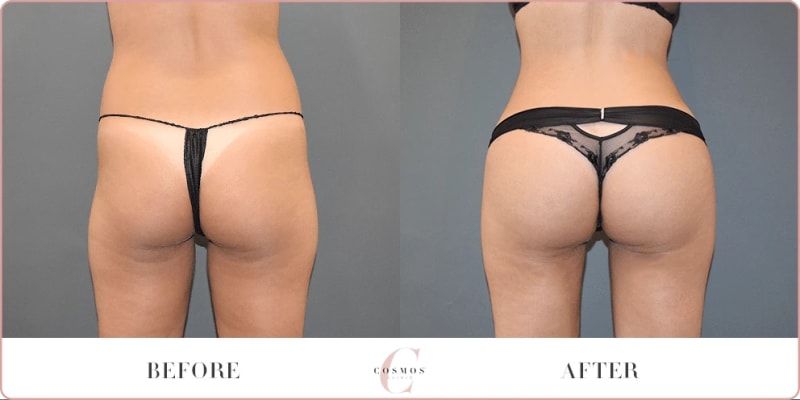Brazilian Butt Lift (BBL) procedure image