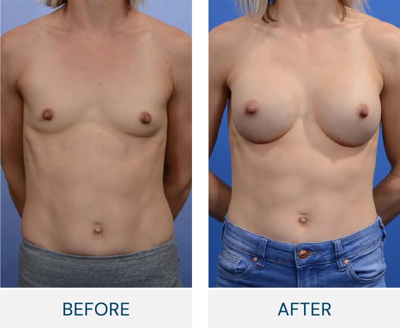Breast Augmentation procedure image