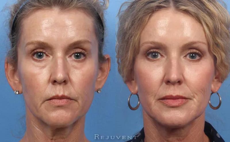 Cheek Enhancement procedure image