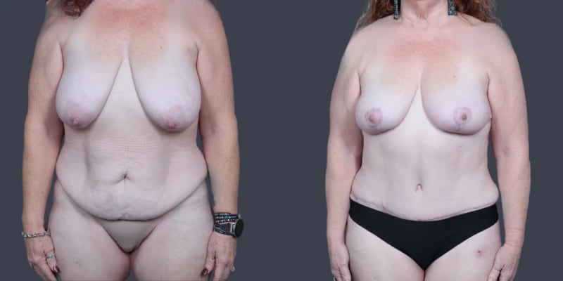 Mommy Makeover procedure image