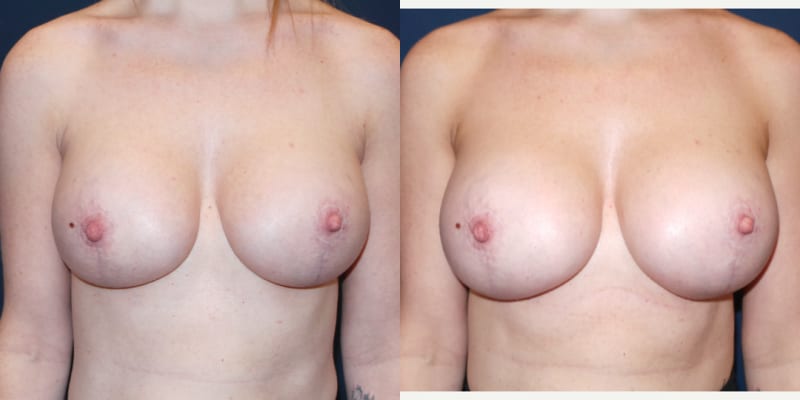 Breast Augmentation procedure image