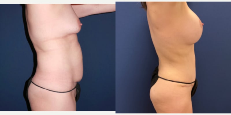 Liposuction procedure image