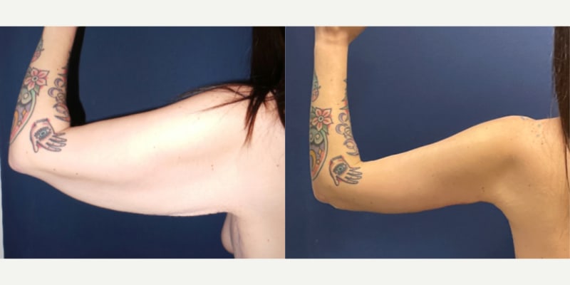 Arm Lift (Brachioplasty) procedure image