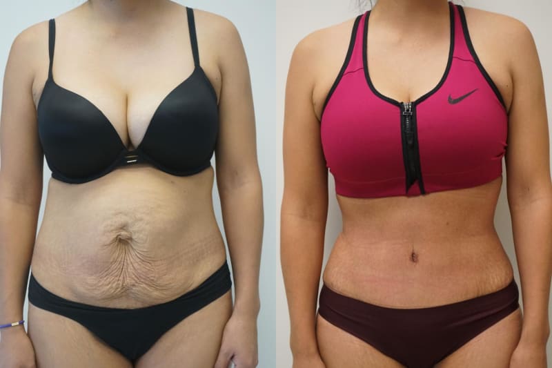 Tummy Tuck (Abdominoplasty) procedure image