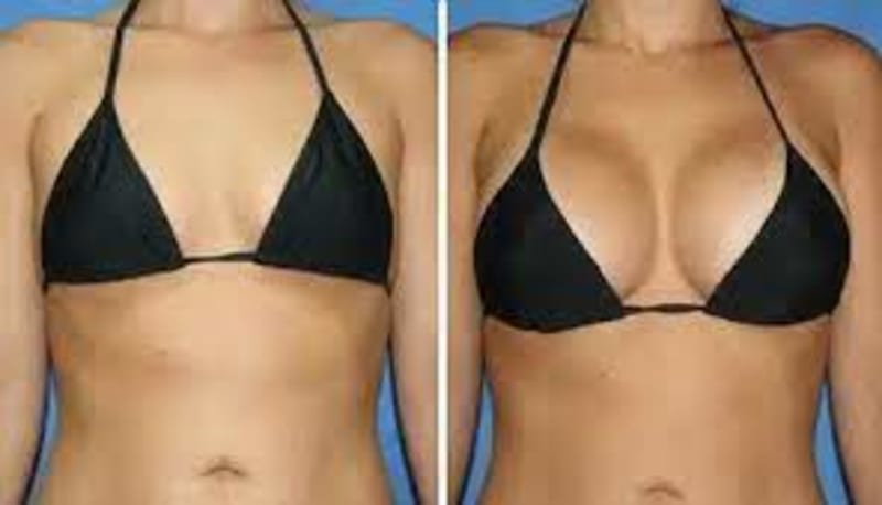 Breast Augmentation procedure image