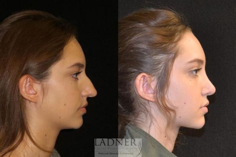 Rhinoplasty (Nose Job) procedure image