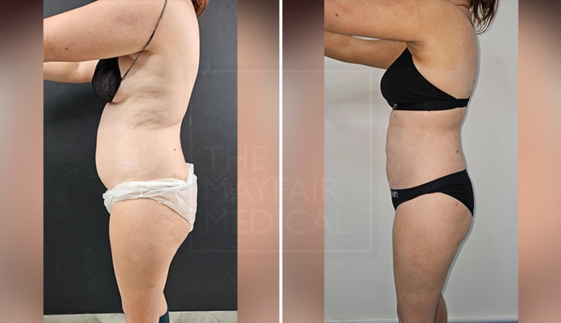 Liposuction procedure image