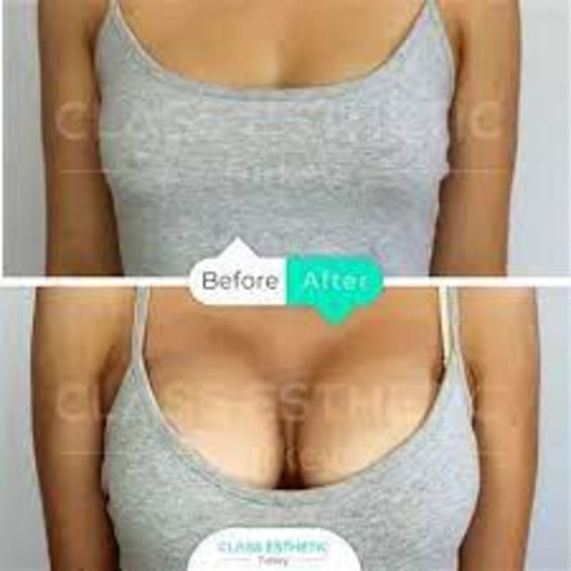 Breast Augmentation procedure image