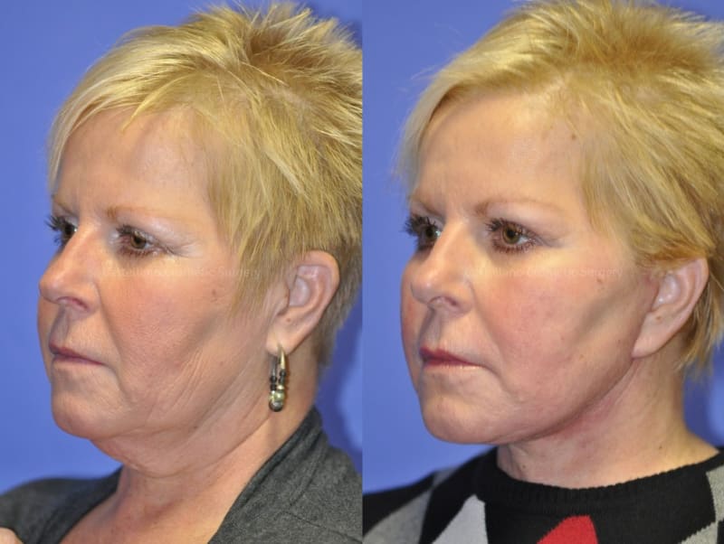 Skin Rejuvenation & Resurfacing procedure image