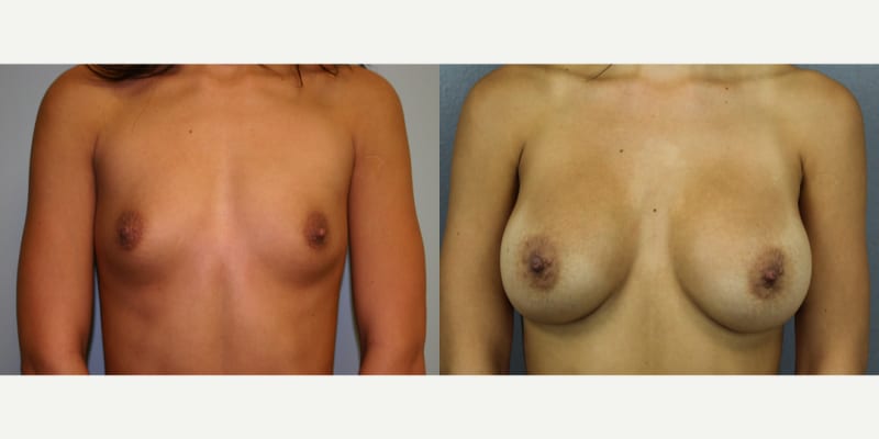 Breast Augmentation procedure image