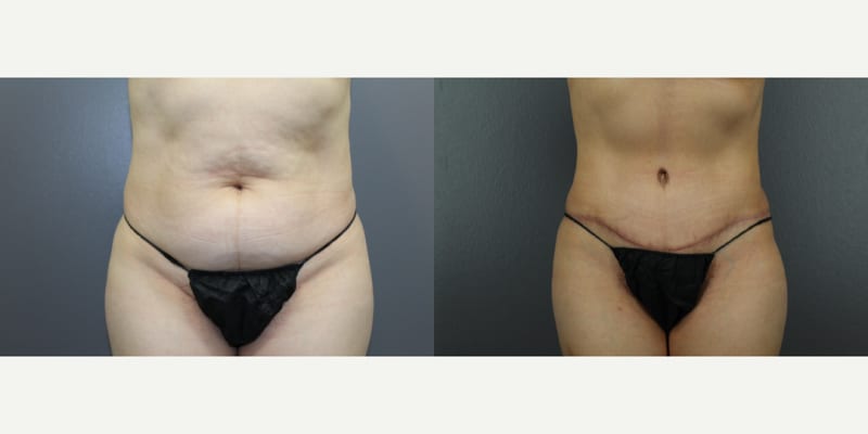 Tummy Tuck (Abdominoplasty) procedure image