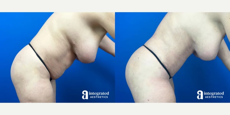 Tummy Tuck (Abdominoplasty) procedure image