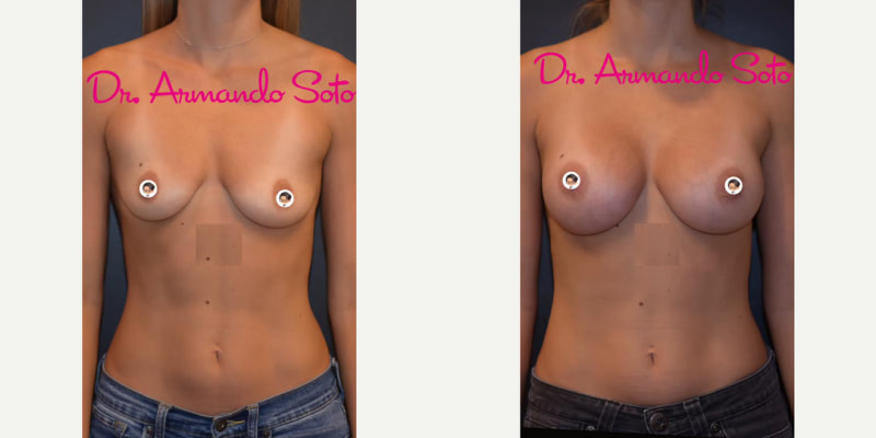 Breast Augmentation procedure image