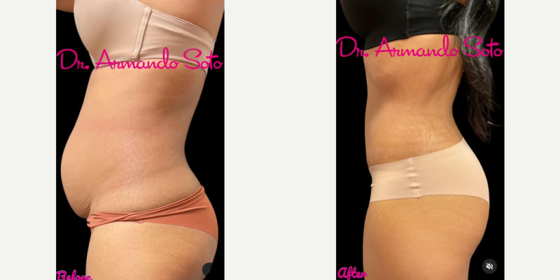 Tummy Tuck (Abdominoplasty) procedure image