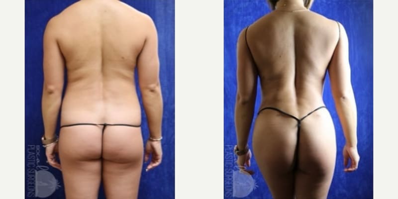 Brazilian Butt Lift (BBL) procedure image