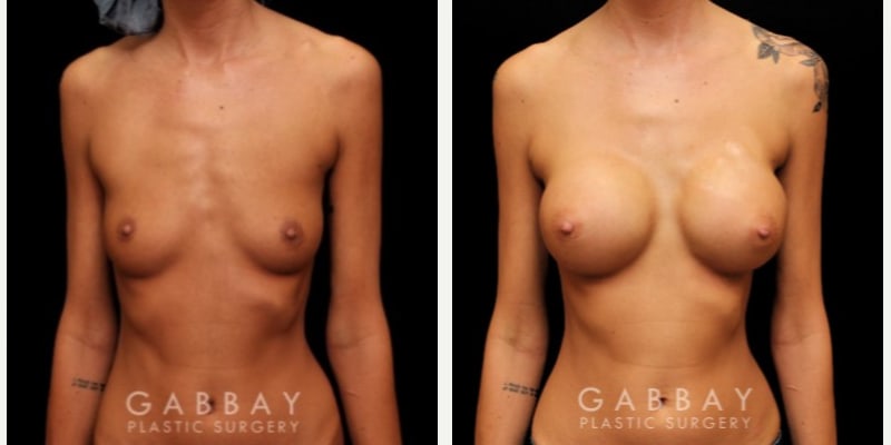 Mommy Makeover procedure image