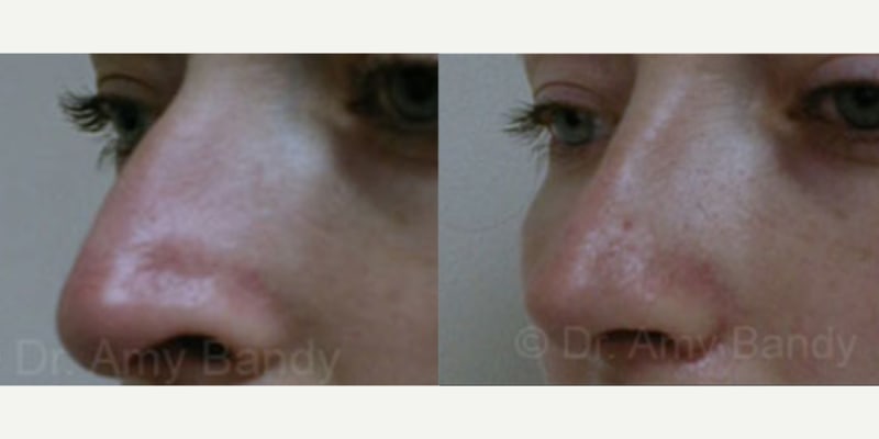 Rhinoplasty (Nose Job) procedure image