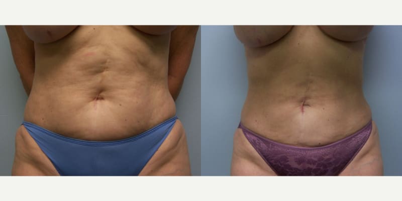 Body Lift procedure image