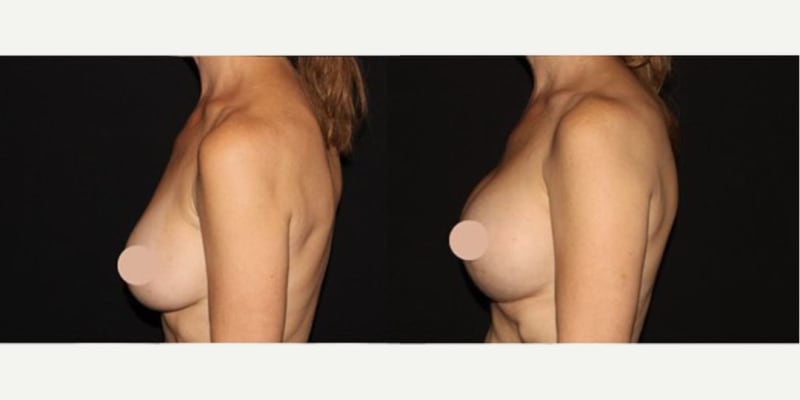 Liposuction procedure image