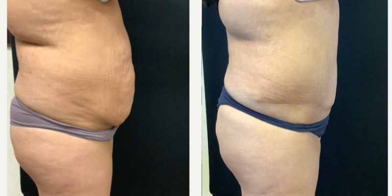 Liposuction procedure image