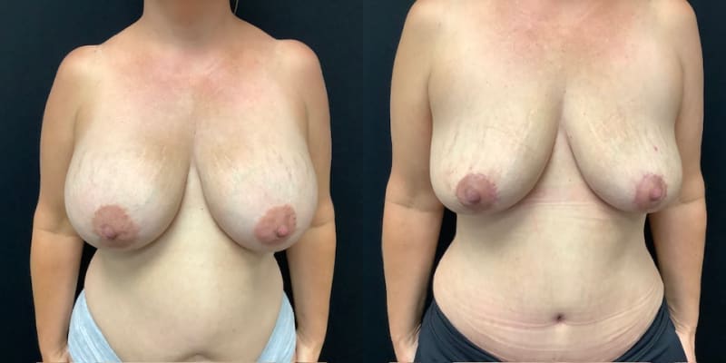 Breast Lift (Mastopexy) procedure image