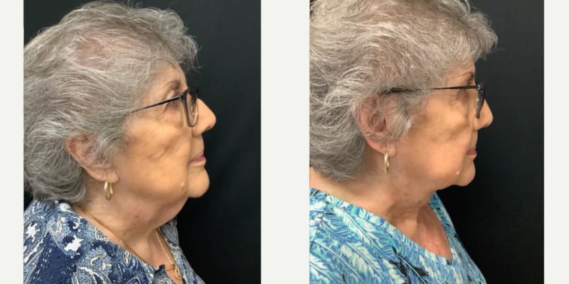 Neck Lift procedure image