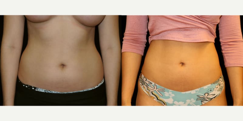 Breast Augmentation procedure image