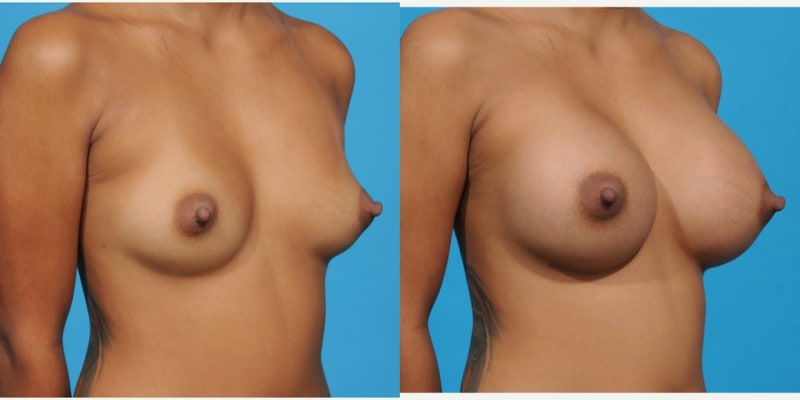 Breast Augmentation procedure image