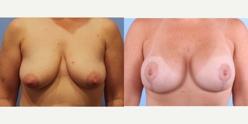 Breast Lift (Mastopexy) procedure image