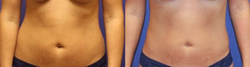 Liposuction procedure image