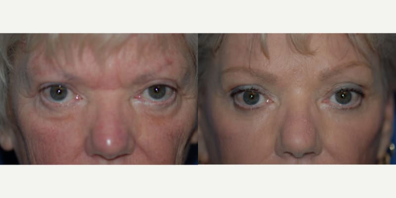 Eyelid Surgery (Blepharoplasty) procedure image