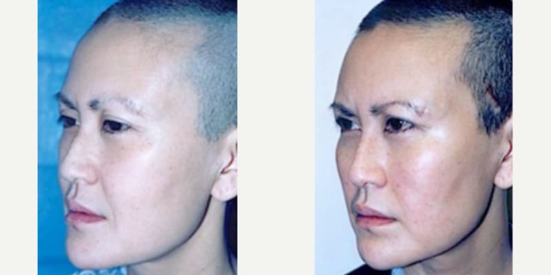 Rhinoplasty (Nose Job) procedure image