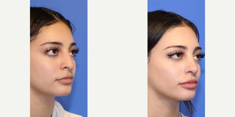 Rhinoplasty (Nose Job) procedure image