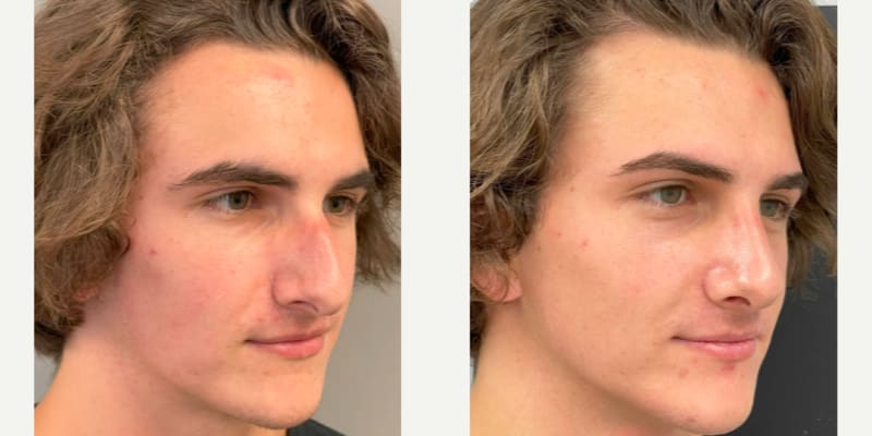 Rhinoplasty (Nose Job) procedure image
