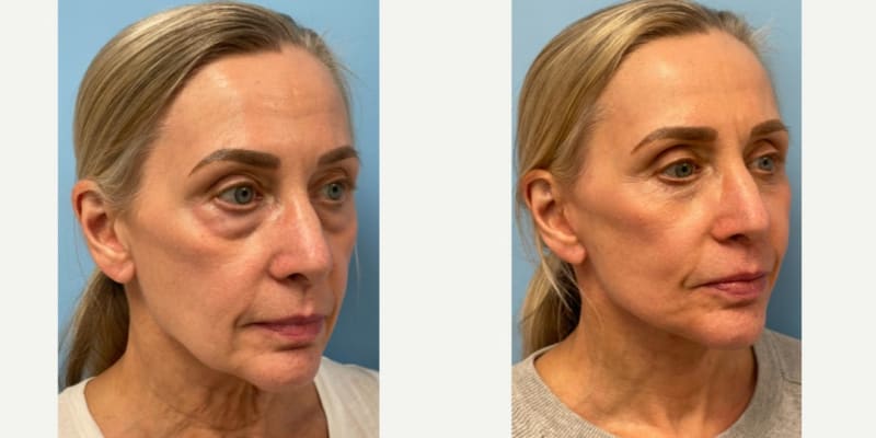 Eyelid Surgery (Blepharoplasty) procedure image