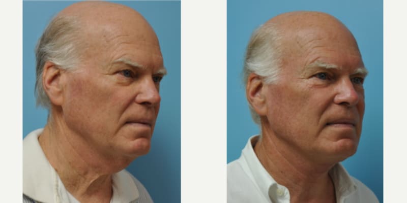 Facelift procedure image