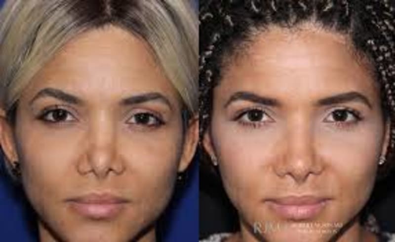 Rhinoplasty (Nose Job) procedure image