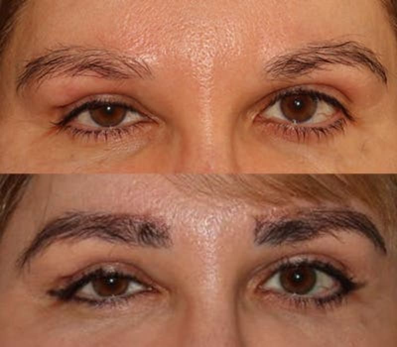 Hair Transplant (FUE / Sapphire FUE) procedure image