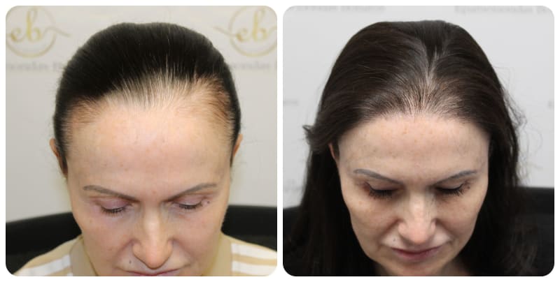 Eyebrow Transplant procedure image