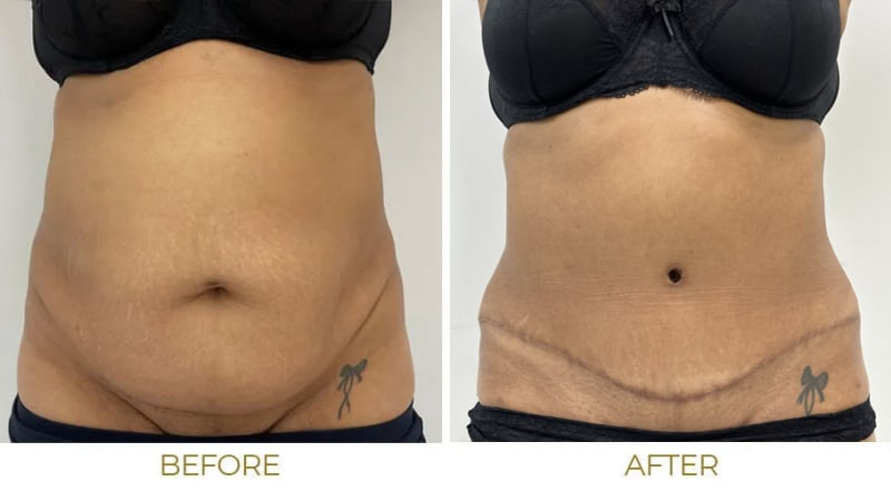 Tummy Tuck (Abdominoplasty) procedure image