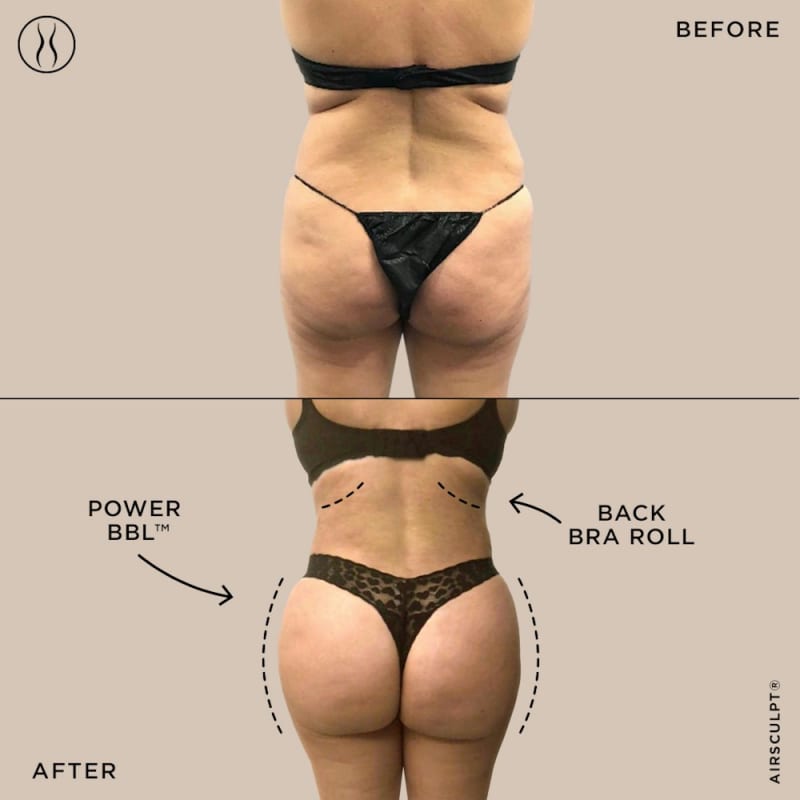 Brazilian Butt Lift (BBL) procedure image
