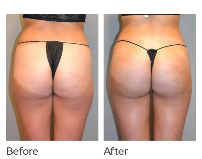 Brazilian Butt Lift (BBL) procedure image