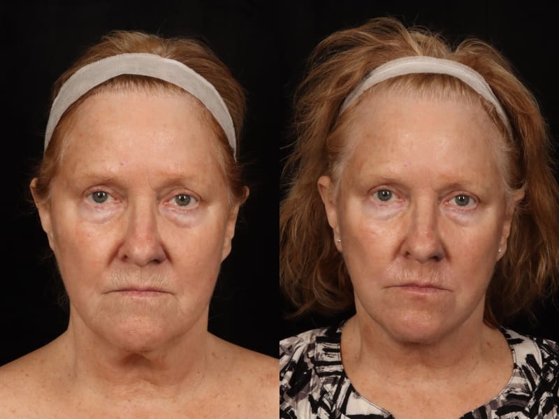 Facelift procedure image
