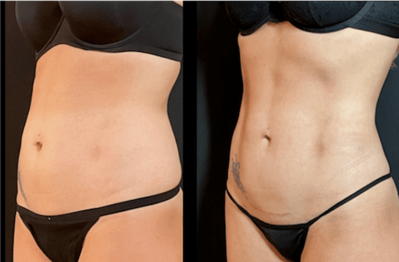 Lipo 360 procedure image