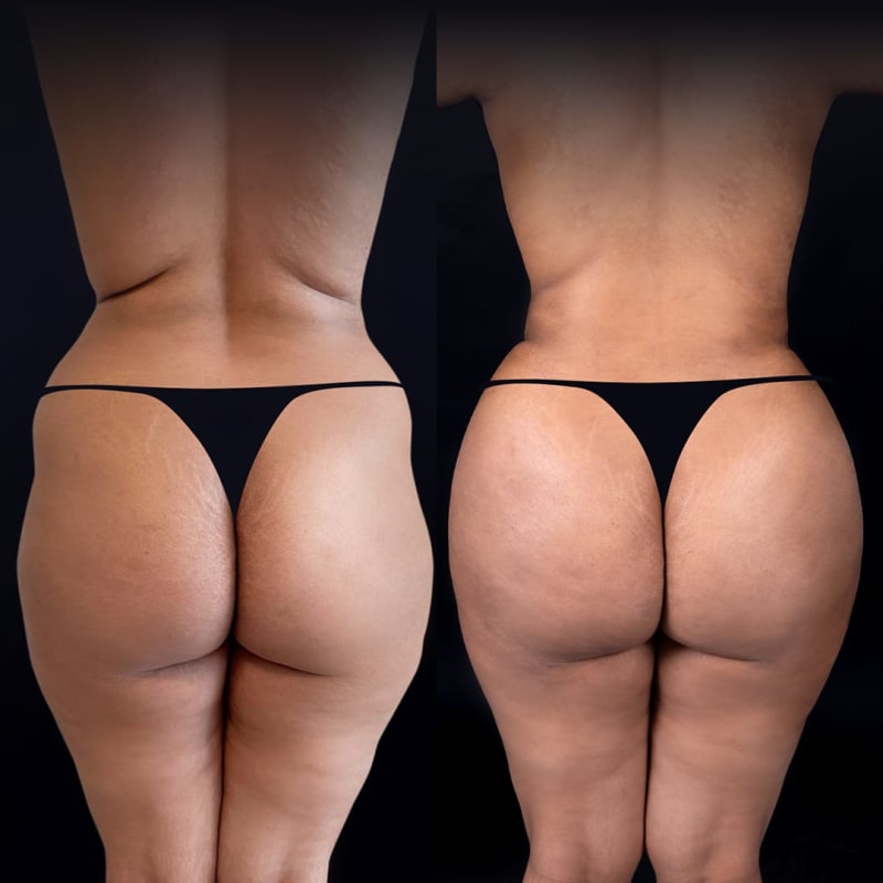 Brazilian Butt Lift (BBL) procedure image