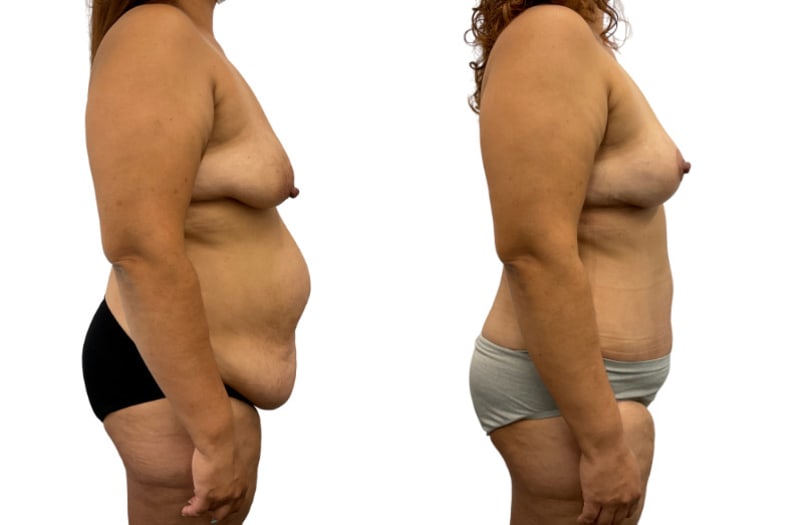 Mommy Makeover procedure image