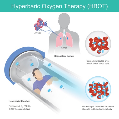 Extracorporeal Membrane Oxygenation